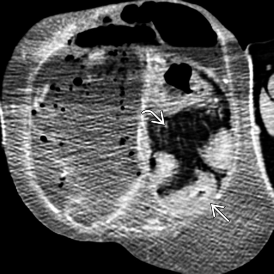 Axial CECT in the same patient illustrates a collection of bowel
and omental fat
within the hernia sac.