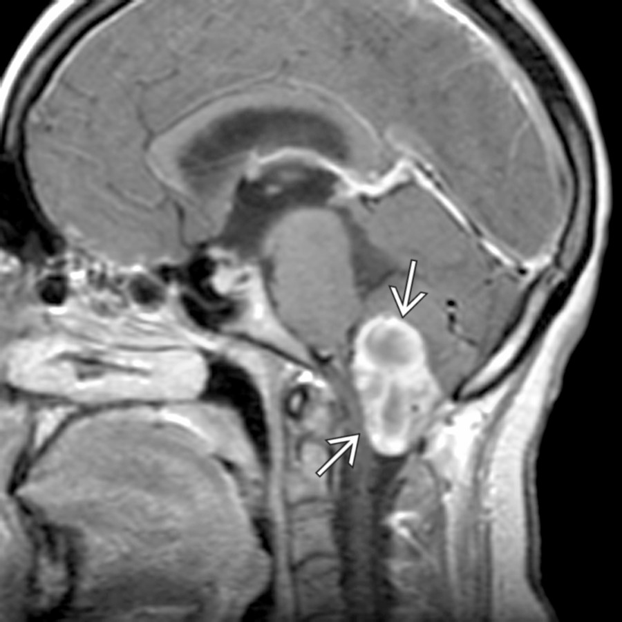 Sagittal T1 C+ MR demonstrates a mostly solid hemangioblastoma
involving the cerebellar tonsils and effacing the cisterna magna.