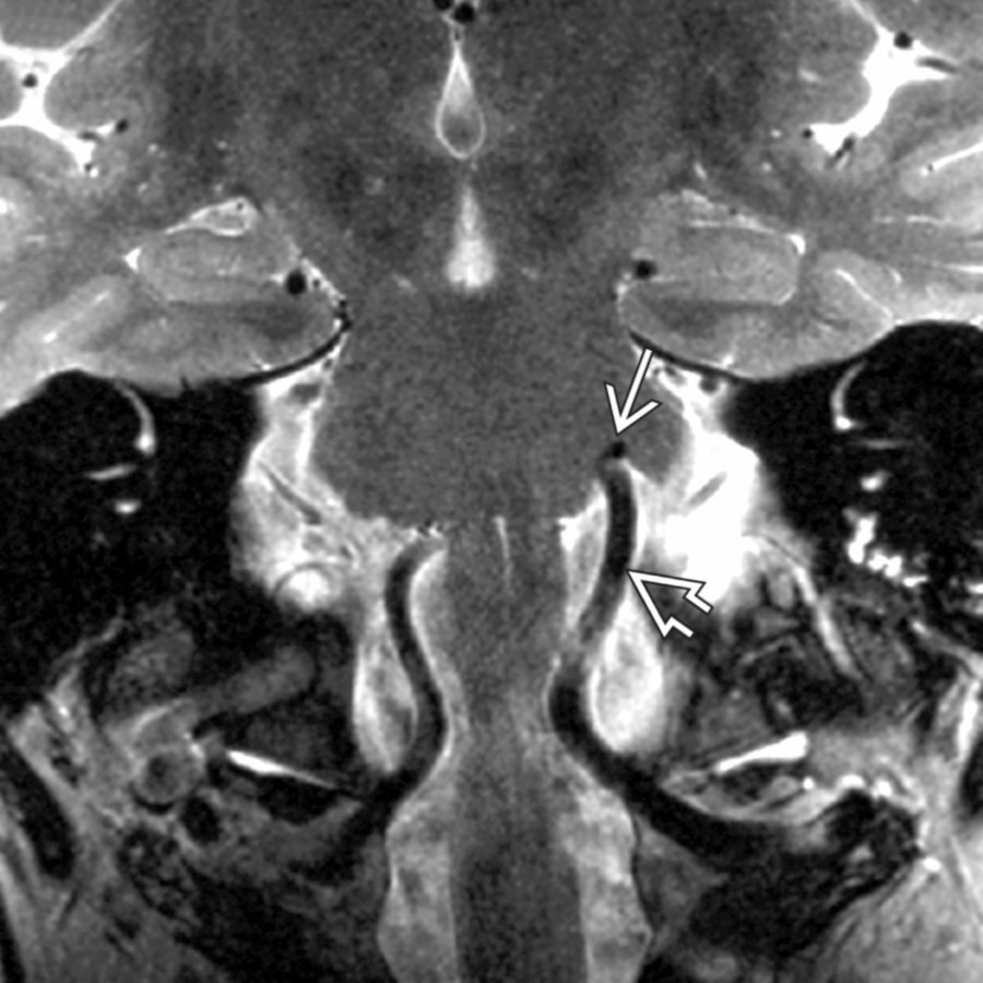 Coronal T2 MR shows an ectatic vertebral artery
"lifting" the posterior inferior cerebellar artery into the root exit zone of the facial nerve
. Note compression of the lateral pons.