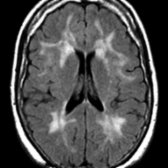 Axial FLAIR MR demonstrates confluent hyperintense white matter changes
that may occur during normal aging.