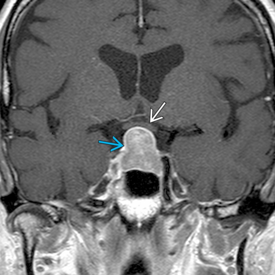 Coronal T1 C+ MR shows an enhancing intrasellar and suprasellar mass
. The pituitary gland cannot be separated from the mass and indeed is the mass. Note the superior displacement of the optic chiasm
by the macroadenoma.