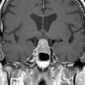 Coronal T1 C+ MR shows an enhancing intrasellar and suprasellar mass
. The pituitary gland cannot be separated from the mass and indeed is the mass. Note the superior displacement of the optic chiasm
by the macroadenoma.