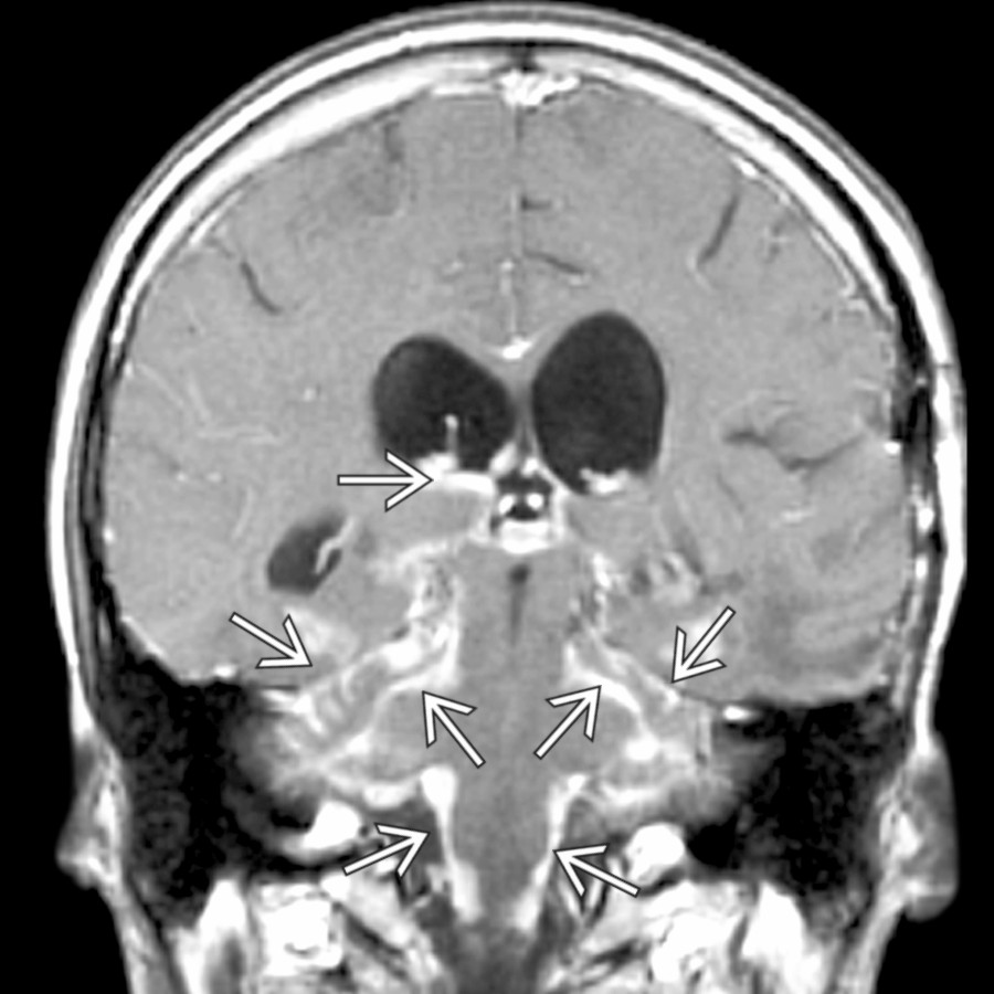 Coronal T1 C+ MR demonstrates the diffuse enhancement of meningeal carcinomatosis from metastatic xanthoastrocytoma
spread throughout the posterior fossa, folia, and also more cephalad.