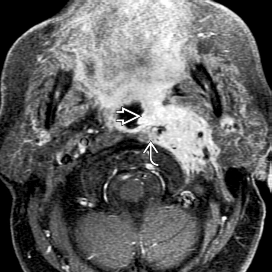 Axial T1 C+ FS MR shows metastatic lung cancer with extensive extracapsular nodal spread. The mass has ill-defined borders with invasion of the longus capitis muscle
and invasion to the pharyngeal mucosal space
.