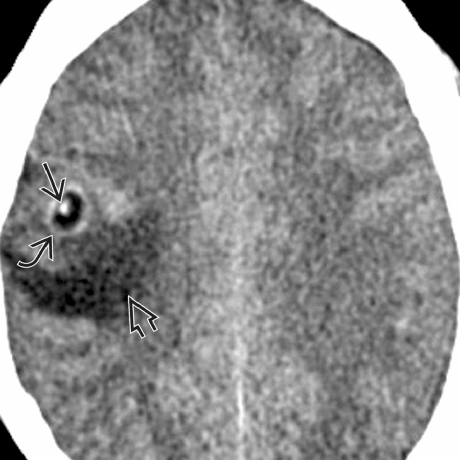 Axial CECT in a young male patient with 1st episode of seizure demonstrates a ring-enhancing lesion
with an eccentric hyperdense "dot"
that denotes scolex. Note the edema
surrounding this colloidal vesicular stage of NCC.