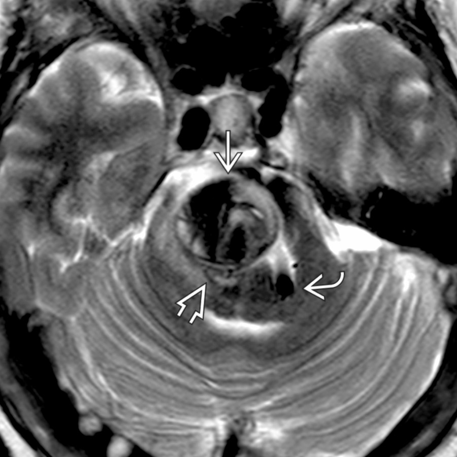 Axial T2 FS MR shows a giant right vetebral artery aneurysm
with complex signal intensity. The aneurysm obliterates the pontomedullary junction at the region of the right CNVII root exit zone
. The same tortuous right vertebral artery
also effaces the left CNVII root exit zone region.