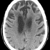 Axial CT shows classic morphologic changes of FTD. Note advanced bilateral frontal lobe atrophy
. In this case, there is also advanced bilateral temporal lobe atrophy (not shown).