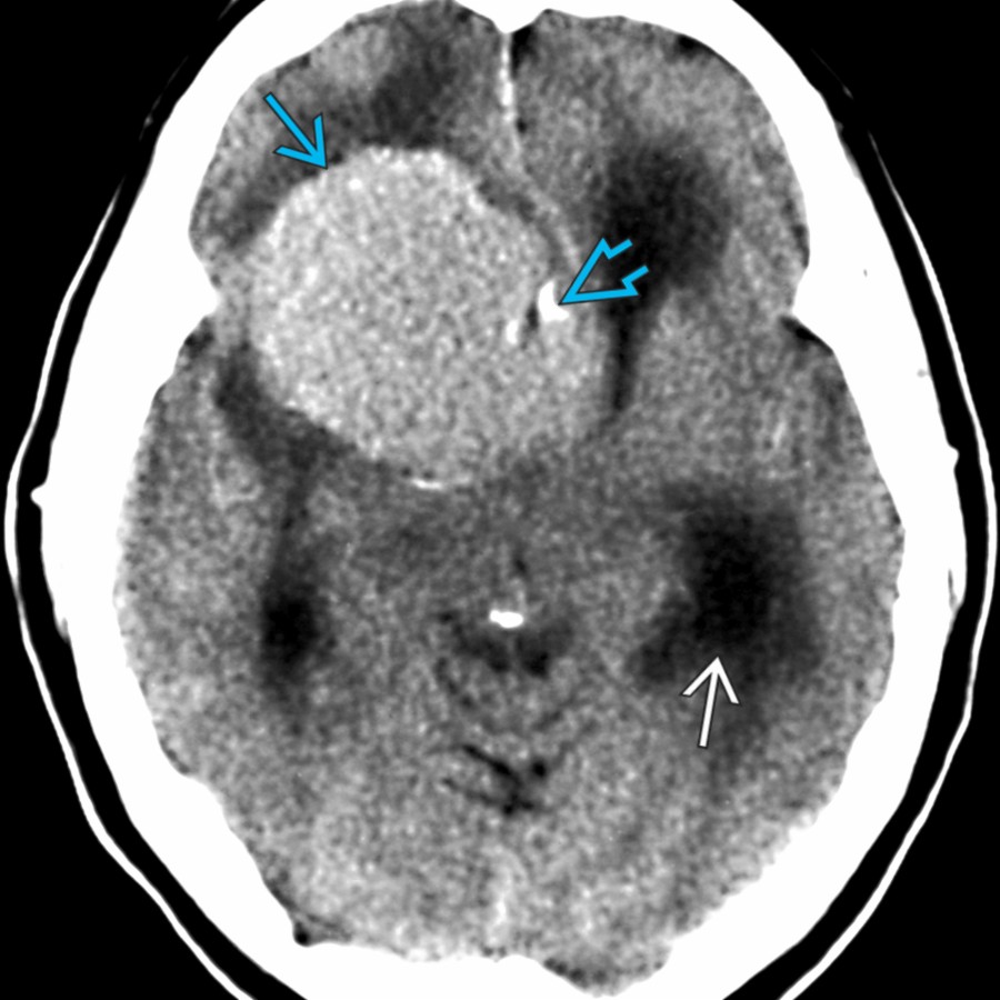 Axial NECT shows a hyperdense suprasellar mass
with focal calcifications
in this patient with a classic meningioma arising from the central skull base. Note the associated hydrocephalus
related to ventricular obstruction.