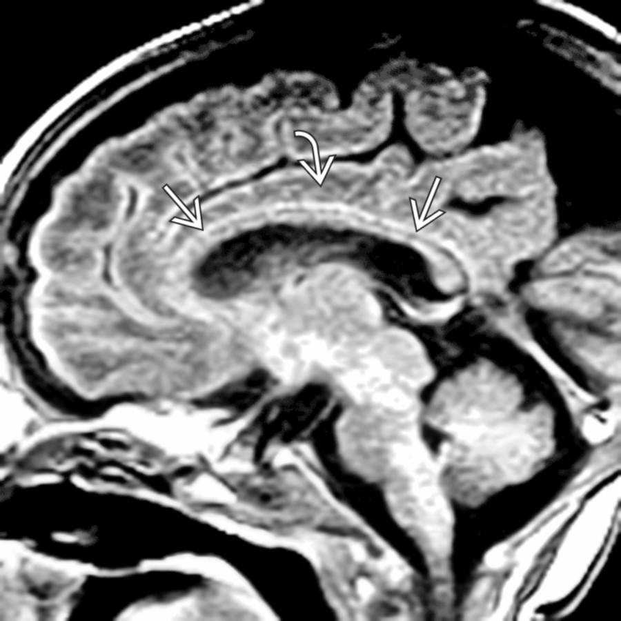 Midline sagittal T1 MR shows a normal neonatal corpus callosum
, thin due to an age-appropriate lack of myelin. The cingulate gyrus
is normal.