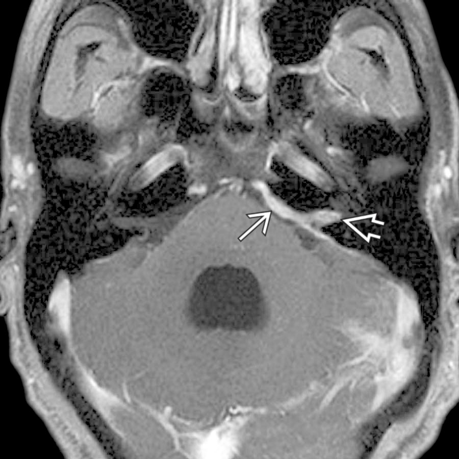 Axial T1 C+ FS MR demonstrates thick enhancing dural-based sarcoidosis in the left CPA
and IAC
mimicking en plaque meningioma.