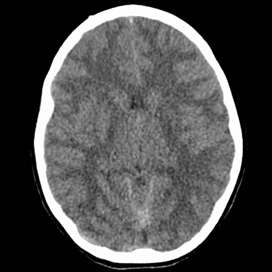 Axial NECT in a 12-year-old with altered mental status and diabetic ketoacidosis shows near-complete effacement of the lateral ventricles, perimesencephalic cisterns, and cerebral sulci related to diffuse cerebral edema.