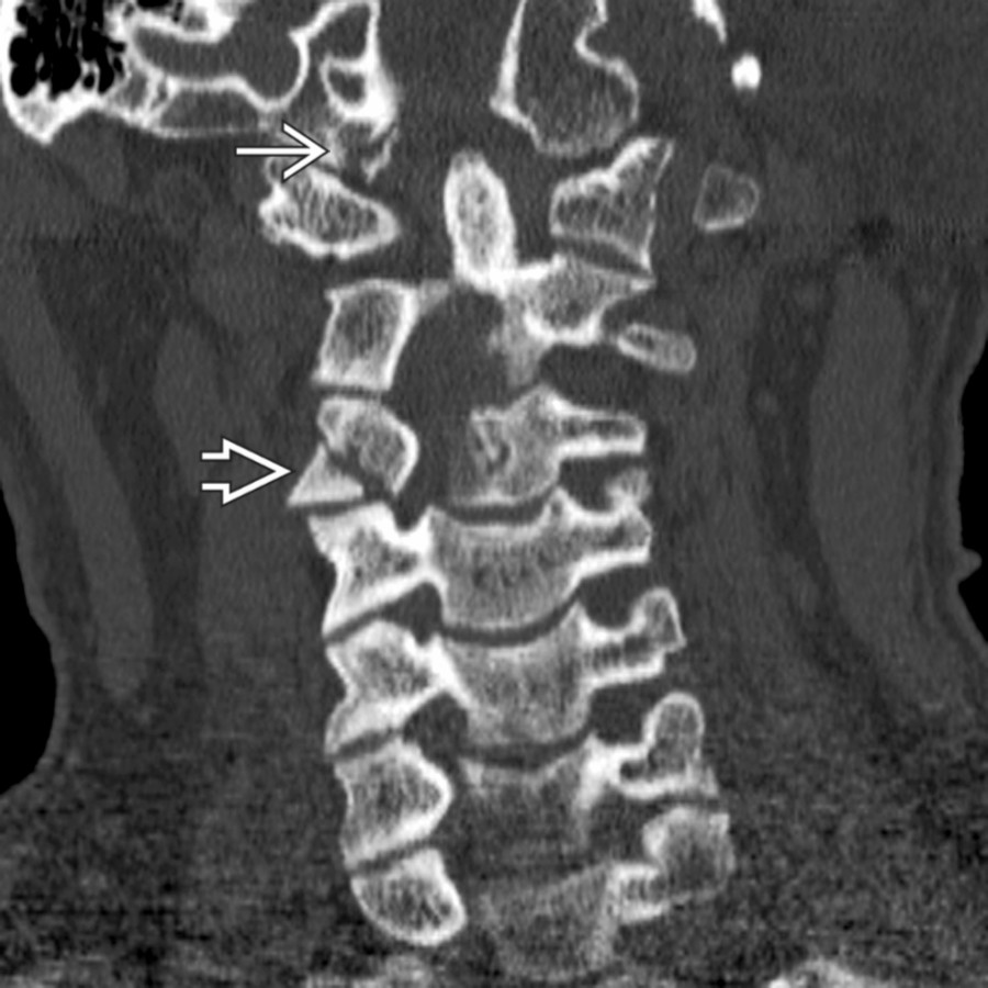 Coronal NECT shows a nondisplaced occipital condyle fracture
as well as a C4 articular pillar fracture
, reflecting lateral flexion injury.