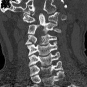Coronal NECT shows a nondisplaced occipital condyle fracture
as well as a C4 articular pillar fracture
, reflecting lateral flexion injury.