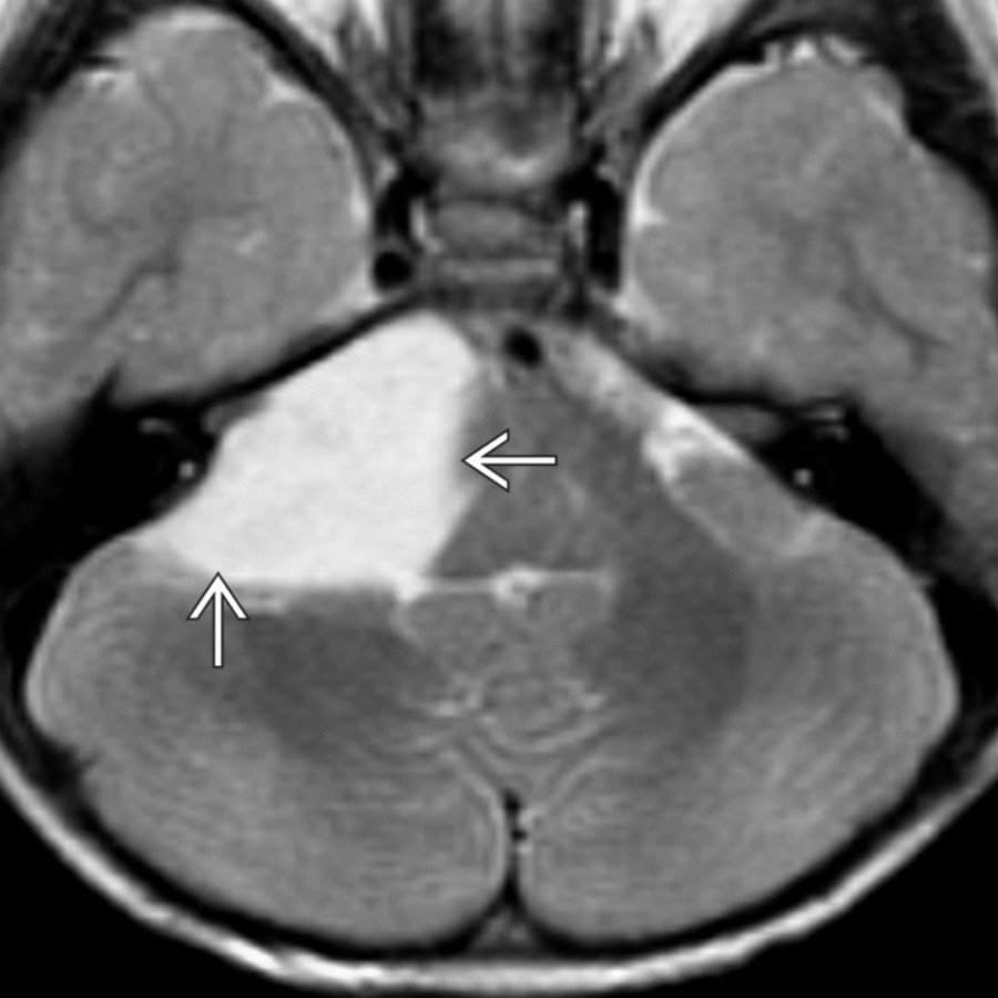 Axial T2WI MR in a 3-year-old child demonstrates a moderate-sized right extraaxial CPA cyst
, isointense to intraventricular fluid, moderately compressing the right cerebellar hemisphere and midbrain.