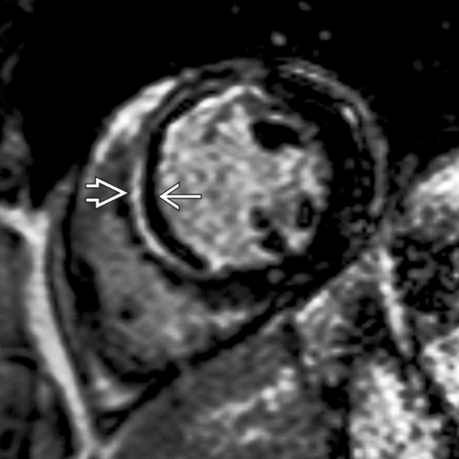 Short-axis inversion recovery FSE MR through the LV mid-chamber shows mid-myocardial LAD distribution late enhancement
. Hypointense subendocardium indicates acute MI associated microvascular obstruction
.