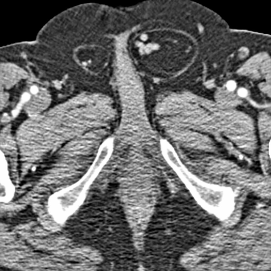 Axial CECT shows a left inguinal hernia containing only fat and spermatic cord.