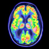 Axial FDG PET/MR shows R > L occipital hypometabolism
with additional involvement of the R > L posterior cingulate gyrus
in a patient with near-cortical blindness.