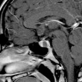 Sagittal T1 C+ MR shows typical appearance of Rathke cleft cyst
between normal adenohypophysis anteriorly
and neurohypophysis posteriorly
. Small lesions may be managed conservatively.
