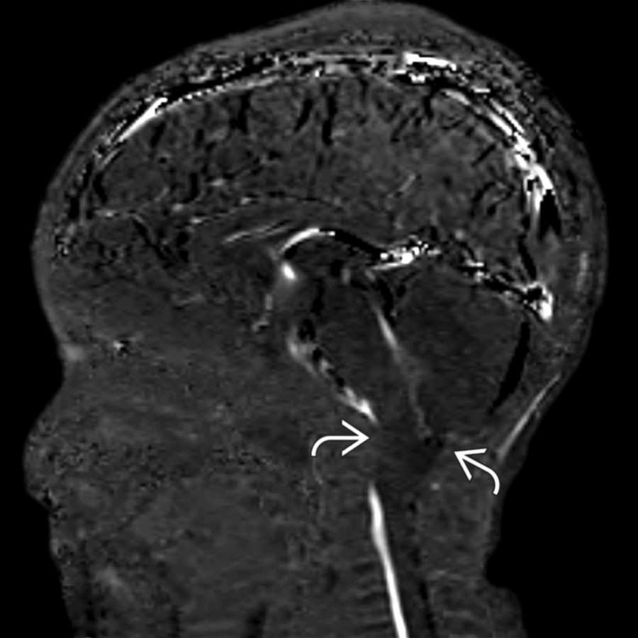 Sagittal phase contrast cine MR (with hyperintense signal at sites of active CSF or venous flow) in the same patient shows absence of CSF flow at the craniocervical junction
due to the CM1.