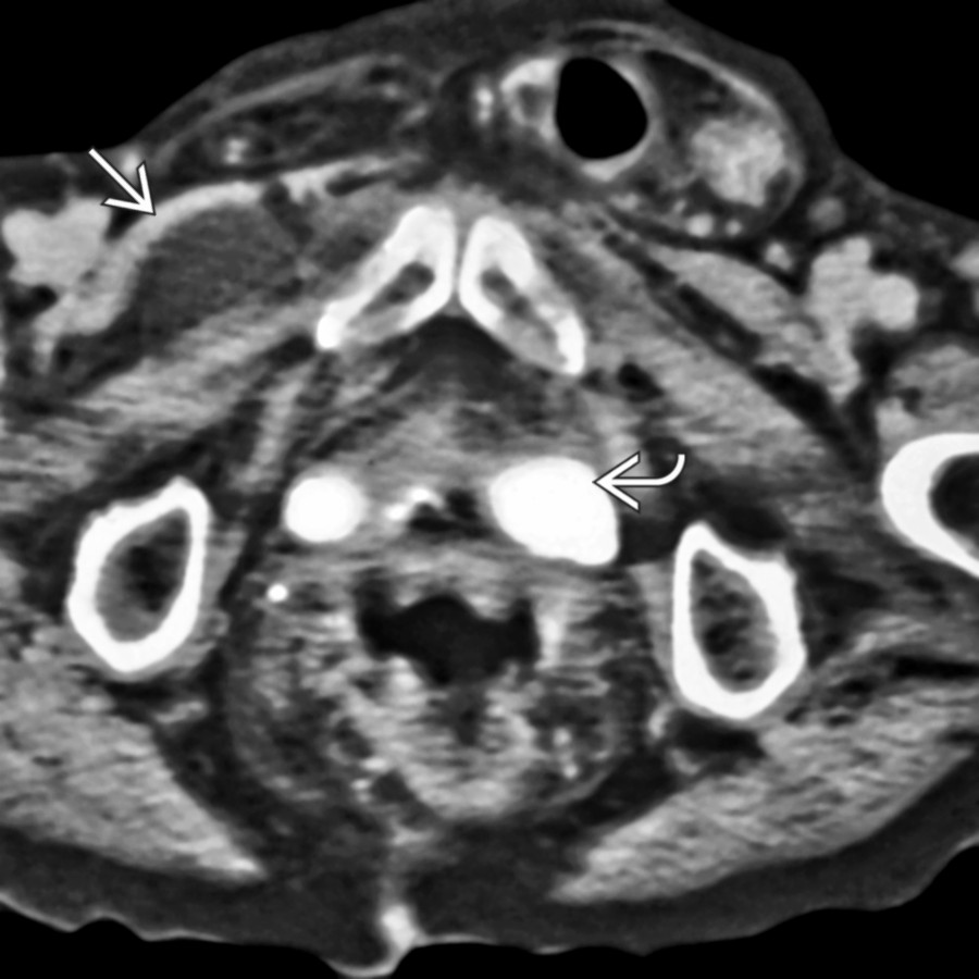 Axial CECT in an older woman shows a left inguinal hernia, right obturator hernia
, and pessary
.