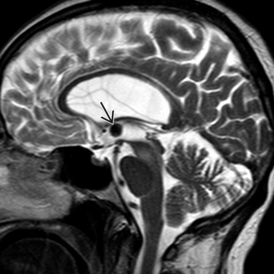 Sagittal T2WI MR in the same patient shows the mass
to be very hypointense, indicating inspissated proteinaceous contents. Note the markedly enlarged lateral ventricle with a normal-sized 3rd ventricle. The CC was removed emergently.