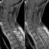 Sagittal T1 C+ FS MR in the same patient demonstrates patchy enhancement
in the cervical and upper thoracic cord. Cord lesions in NMOSD typically extend over 3 or more contiguous vertebral segments. There is involvement of the central gray matter or central and peripheral regions of the cord with > 50% cord area in the axial plane.