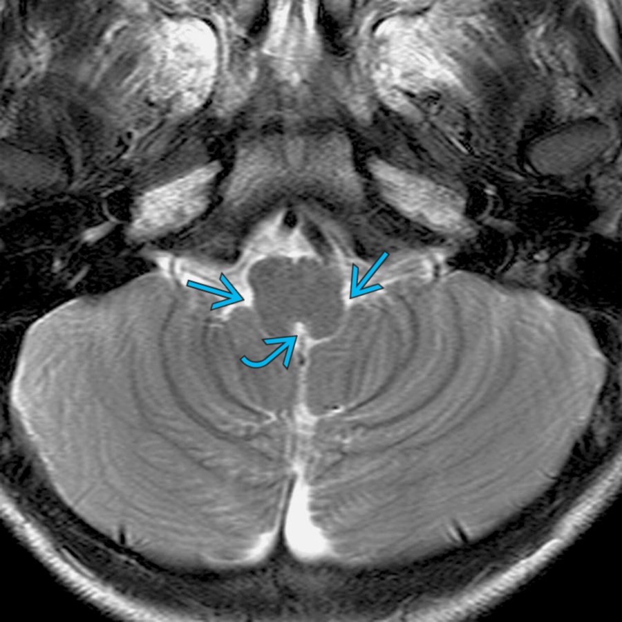 Axial T2 MR at the level of the 4th ventricular outlet shows the foramen of Magendie
and foramina of Luschka
.
