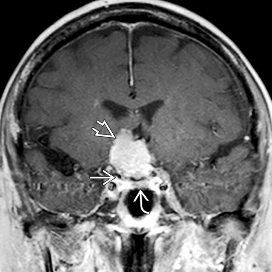 Coronal T1 C+ FS MR shows a suprasellar enhancing mass
separated from the normal pituitary gland below
by a thin black line of diaphragma sellae
.
