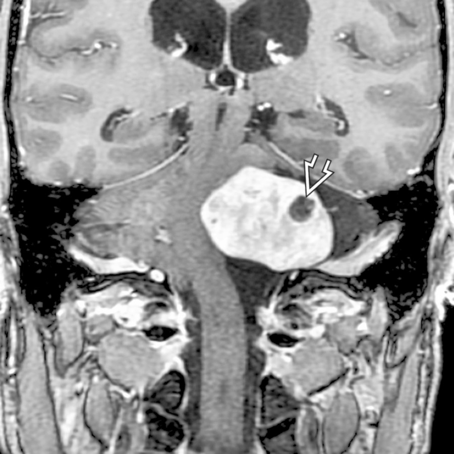 Coronal T1 C+ MR shows variant MR case of a jugular foramen schwannoma with intramural cyst
and very large cisternal component. The jugular foramen connection is seen on the next image.