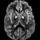 Axial FLAIR MR demonstrates the eye of the tiger appearance in a 5-year-old boy diagnosed with cerebral palsy. The hypointense signal
surrounding the central pallidal hyperintensity is somewhat subtle. The findings are typical of PKAN, formerly known as Hallervorden-Spatz syndrome.