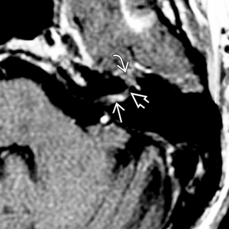 Axial T1 C+ MR shows a small facial nerve schwannoma of the lateral IAC
, labyrinthine segment
, and geniculate ganglion
portions of the facial nerve.