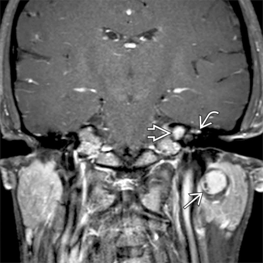 Coronal T1 C+ FS MR in the same patient shows an enhancing schwannoma along the main trunk of the facial nerve with the target sign & small intratumoral cysts
. An additional clue to the diagnosis is contiguous enhancing tumor along the intratemporal facial nerve
extending into the IAC
.