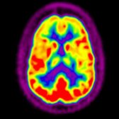 Axial F-18 FDG PET shows findings associated with FTD, predominantly frontal
and temporal lobe hypometabolism, the latter not shown.