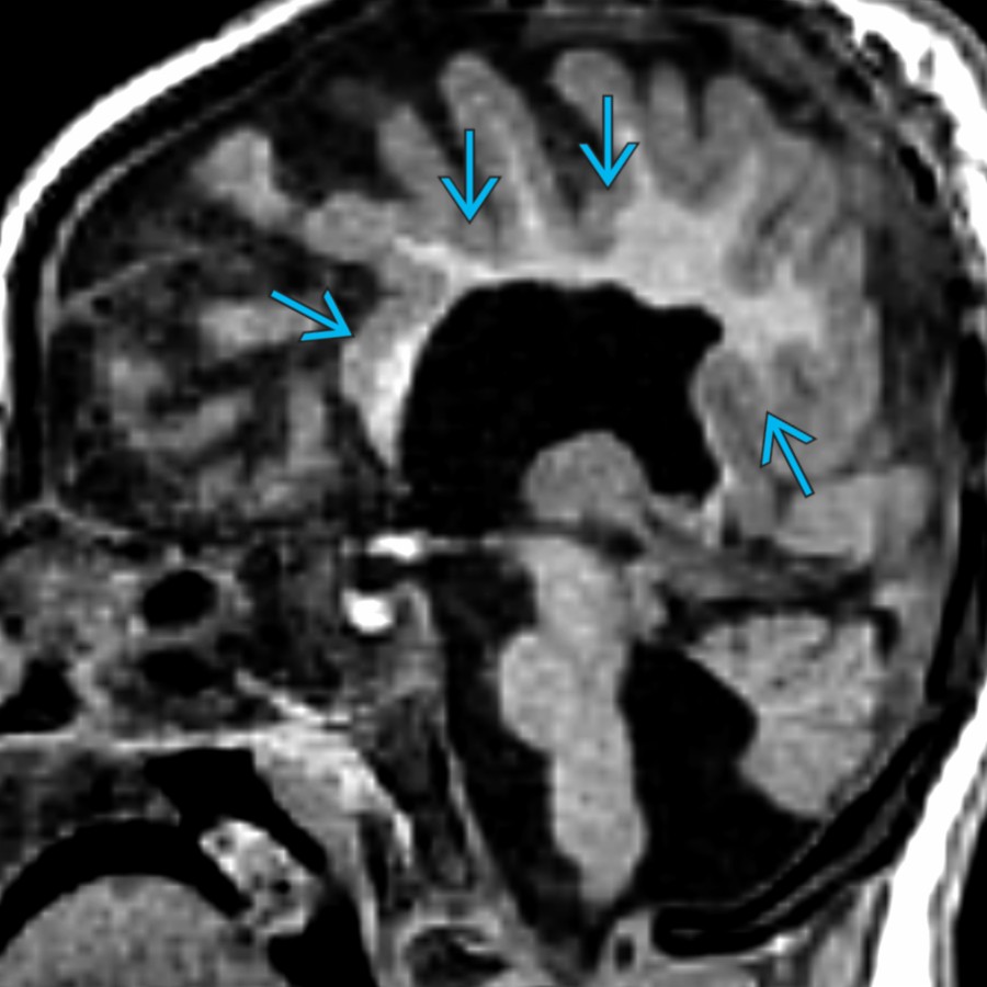 Midline sagittal T1 MR in a 2 year old with semilobar holoprosencephaly shows absence of a normal CC & extension of cortical GM
across the midline.