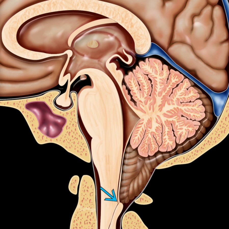 Sagittal graphic demonstrates pointed cerebellar tonsils extending below the foramen magnum to the inferior aspect of the C1 posterior arch. The obex
is inferiorly displaced as well.