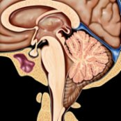 Sagittal graphic demonstrates pointed cerebellar tonsils extending below the foramen magnum to the inferior aspect of the C1 posterior arch. The obex
is inferiorly displaced as well.