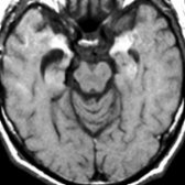 Axial T1 MR shows hyperintensity representing blood products in the medial temporal lobes in this patient with treated lung cancer and limbic encephalitis. Blood products are rare in limbic encephalitis, in which imaging mimics herpes encephalitis.