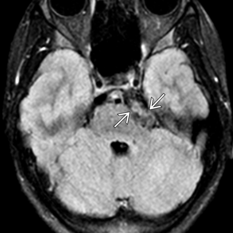 Axial FLAIR MR in the same patient as shows heterogeneous, "dirty" signal intensity within the lesion
adjacent to the pons, hyperintense relative to CSF. Incomplete suppression on FLAIR sequences is typical of epidermoid cysts.
