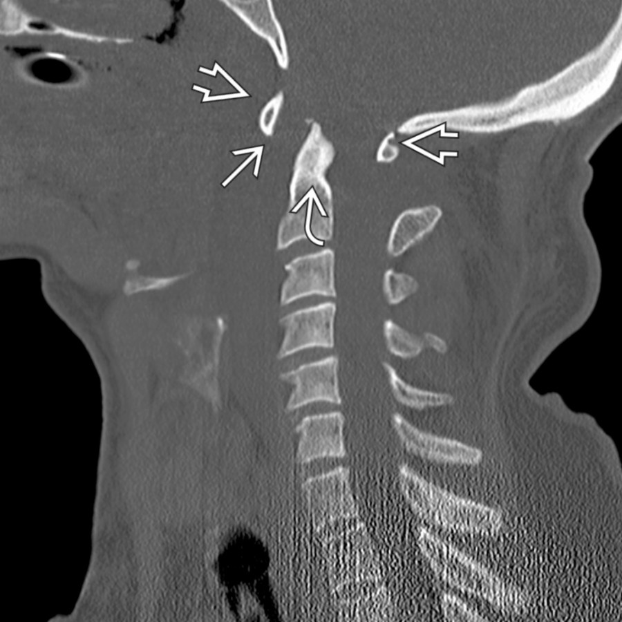 Sagittal CT shows gross widening of the atlantoodontoid articulation
. The ring of C1 has maintained position with respect to the foramen magnum
, but C2 is displaced posteriorly
.