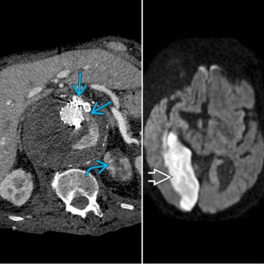 Axial oblique CTA (L) after branch fenestrated endovascular thoracoabdominal aortic aneurysm repair for a ruptured aneurysm shows both type III endoleak at left renal artery and superior mesenteric artery origin
. The left kidney is infarcted
. DWI image (R) 1 day after repair shows a large PCA territory infarct
.