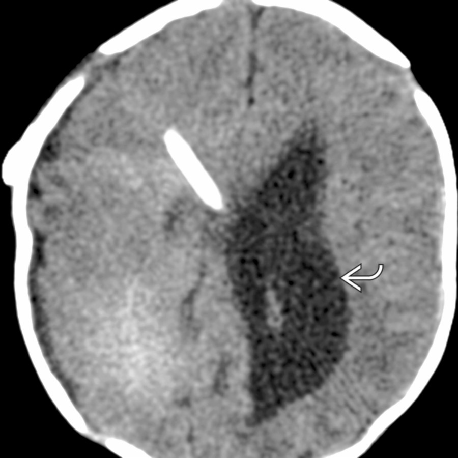Axial NECT shows a right frontal ventricular drain that traverses the right ventricle but is not decompressing the left lateral ventricle, which remains irregularly enlarged
.