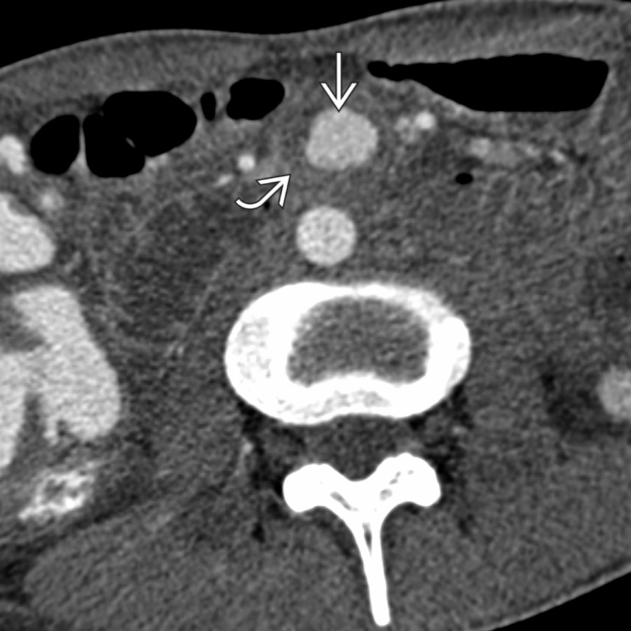 Axial CTA of the abdomen shows a pseudoaneurysm
arising from a branch of the superior mesenteric artery. Note the perianeurysmal soft tissue
.