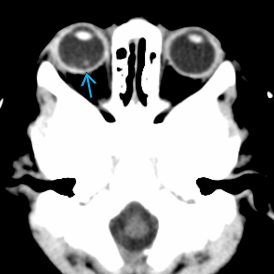 Axial NECT in a 6-month-old girl with AHT shows high attenuation
in the posterior right globe, consistent with retinal hemorrhage. Retinal hemorrhage is rarely seen on CT but strongly suggests nonaccidental trauma (NAT).