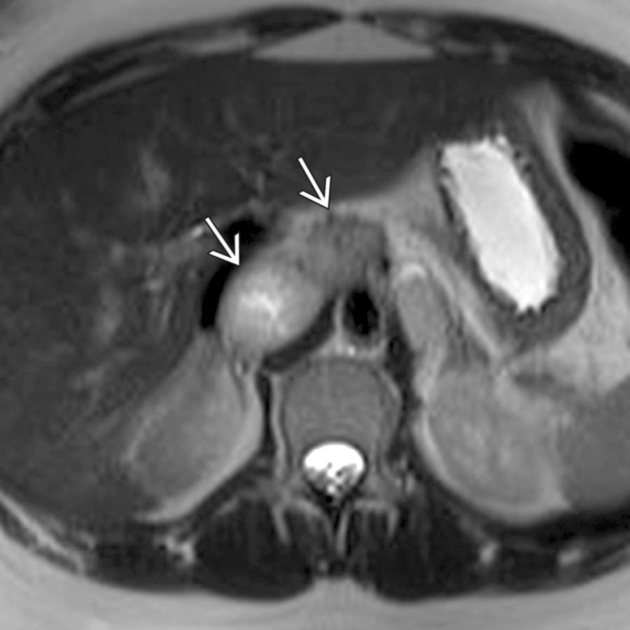 Axial T2WI MR shows 2 well-circumscribed, paraaortic paragangliomas
.