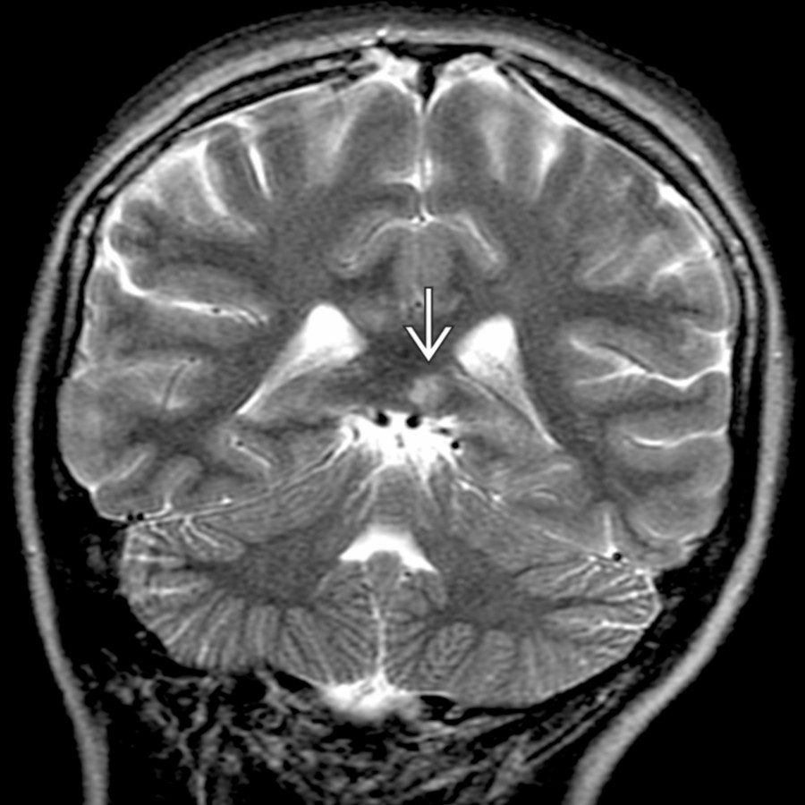 Coronal T2 FS MR in a patient with retinocochleocerebral vasculopathy (Susac syndrome) shows a characteristic round, hyperintense lesion in the splenium of the corpus callosum
.