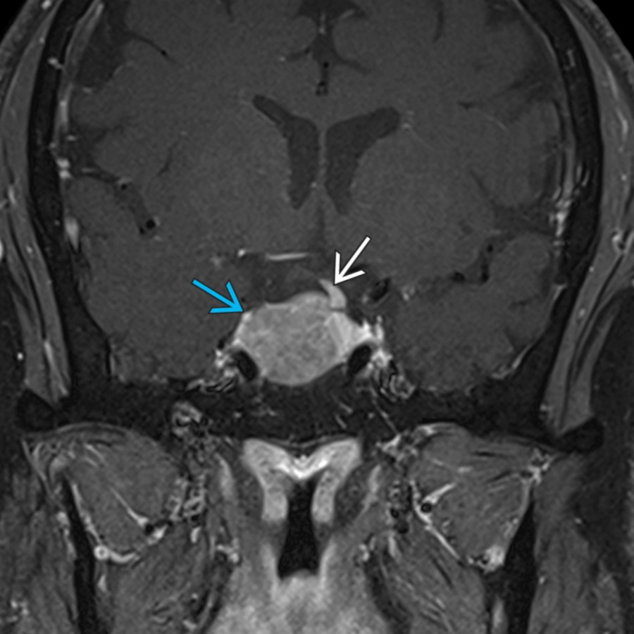 Coronal T1 C+ MR shows an enlarged pituitary gland
related to a macroadenoma. Note displacement of the pituitary infundibulum
to the contralateral side, typical of adenomas.