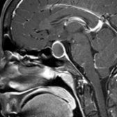 Sagittal T1 C+ FS MR shows a Rathke cleft cyst with claw sign
of residual enhancing pituitary gland draped around the large, intra- and suprasellar cyst.