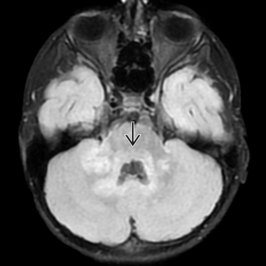 Axial FLAIR MR in a 5-year-old patient with florid encephalopathy and emesis reveals multifocal T2-hyperintense lesions predominantly localizing to the brainstem and posterior fossa. Lesions are noted in the middle cerebellar peduncles, deep cerebellar white matter, and dorsal brainstem
near the facial colliculus (area postrema, explaining vomiting).