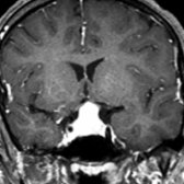 Coronal T1 C+ FS MR in the same patient shows intense enhancement of the mass
. Preoperative diagnosis was macroadenoma. LH was found at surgery.