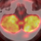 Axial F-18 FDG PET/CT in the same patient performed for lung cancer restaging is shown. Axial fused images through the inferior aspect of posterior fossa show asymmetric ↓ metabolic activity in the right cerebellum
due to CCD. (Courtesy M. Matesan, MD.)